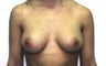 Breast Augmentation
