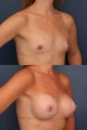 Breast Augmentation