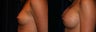 Breast Augmentation