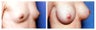 Breast Augmentation