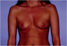 Breast Augmentation