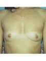Breast Augmentation