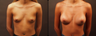 Breast Augmentation