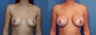 Breast Augmentation