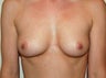 Breast Augmentation