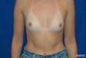 Breast Augmentation