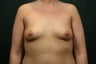 Breast Augmentation