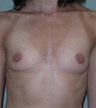Breast Augmentation