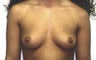 Breast Augmentation
