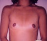 Breast Augmentation