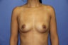Breast Augmentation