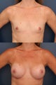 Breast Augmentation