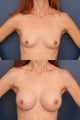 Breast Augmentation
