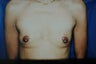 Breast Augmentation