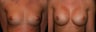 Breast Augmentation