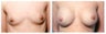 Breast Augmentation