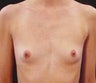 Breast Augmentation