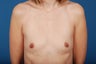 Breast Augmentation