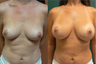 Breast Augmentation