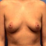 Breast Augmentation