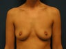 Breast Implants