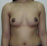 Breast Augmentation