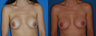 Breast Implant Revision