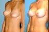 Breast Implants