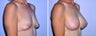 Breast Implants