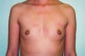 Breast Implants
