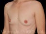 Breast Implants