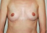 Breast Implants
