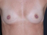 Breast Implants