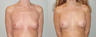 Breast Implants