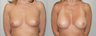 Breast Implants