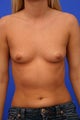 Breast Implants