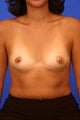 Breast Implants