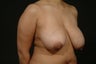 Breast lift