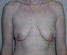 Breast lift