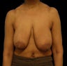 Breast lift