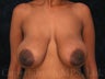 Breast lift