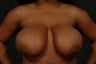 Breast reduction