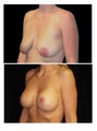 Breast lift