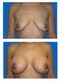 Breast lift