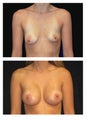 Breast lift