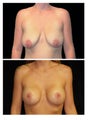 Breast lift