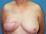 Breast reconstruction
