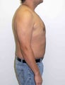 Male breast reduction
