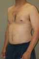 Male breast reduction