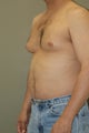 Male breast reduction